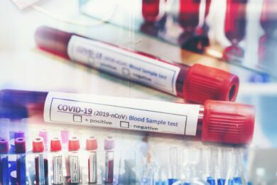 Test sierologico per il dosaggio degli anticorpi anti SARS-CoV-2